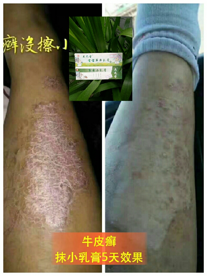 手脚脱皮,鹅掌风)体股癣,花斑癣(汗斑),牛皮癣 ③疹类:湿疹,荨麻疹
