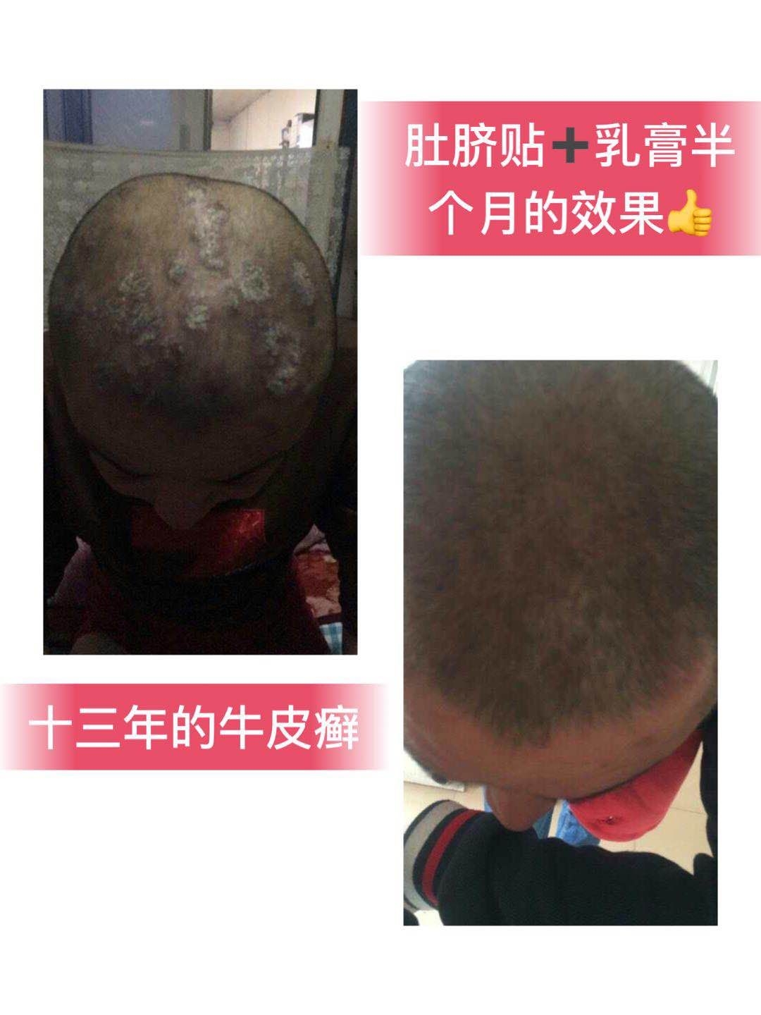 牛皮癣的治疗,是难题吗no