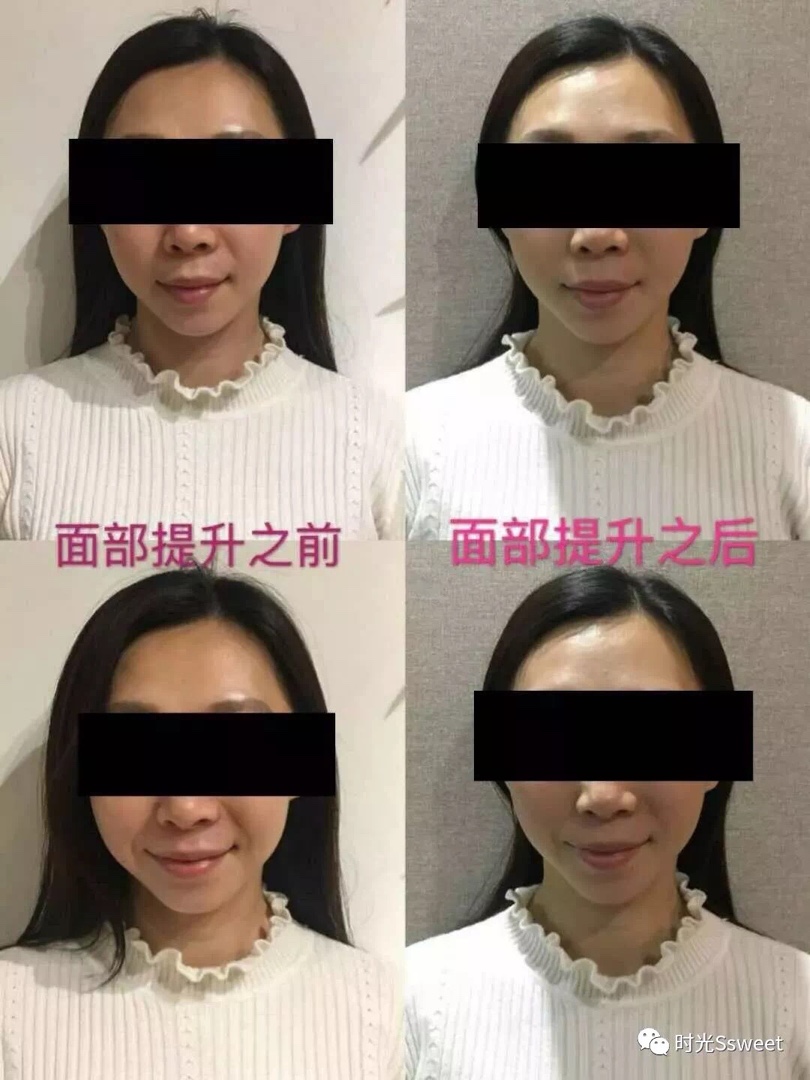 4,面部提升简介