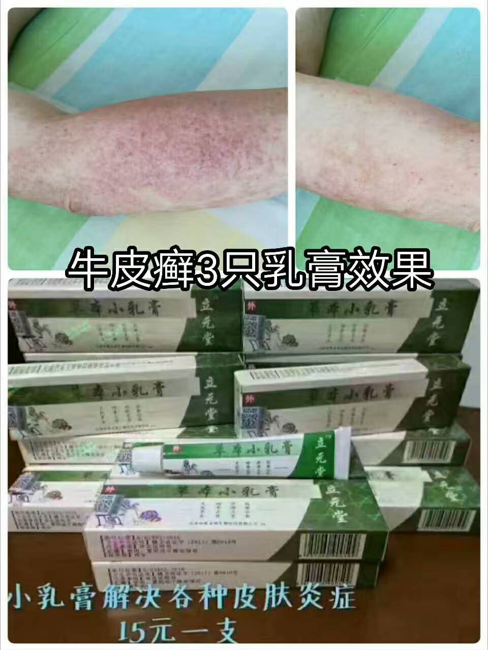 小乳膏治疗范围: ①各类皮炎(神经性,日光性,过敏性) ②癣类:手足癣